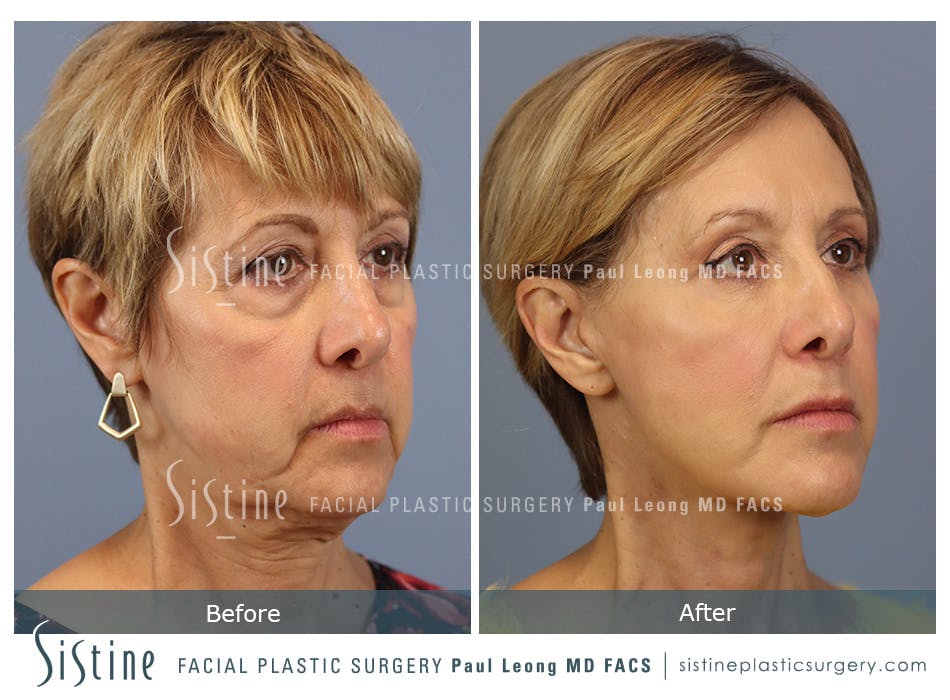 Facelift Before and After | Leong Facial Plastic Surgery