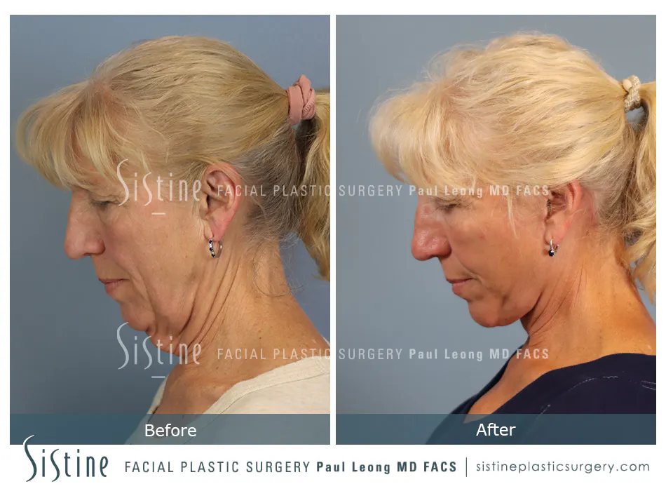 High SMAS Facelift in Pittsburgh - Preoperative Frontal View | Sistine Facial Plastic Surgery