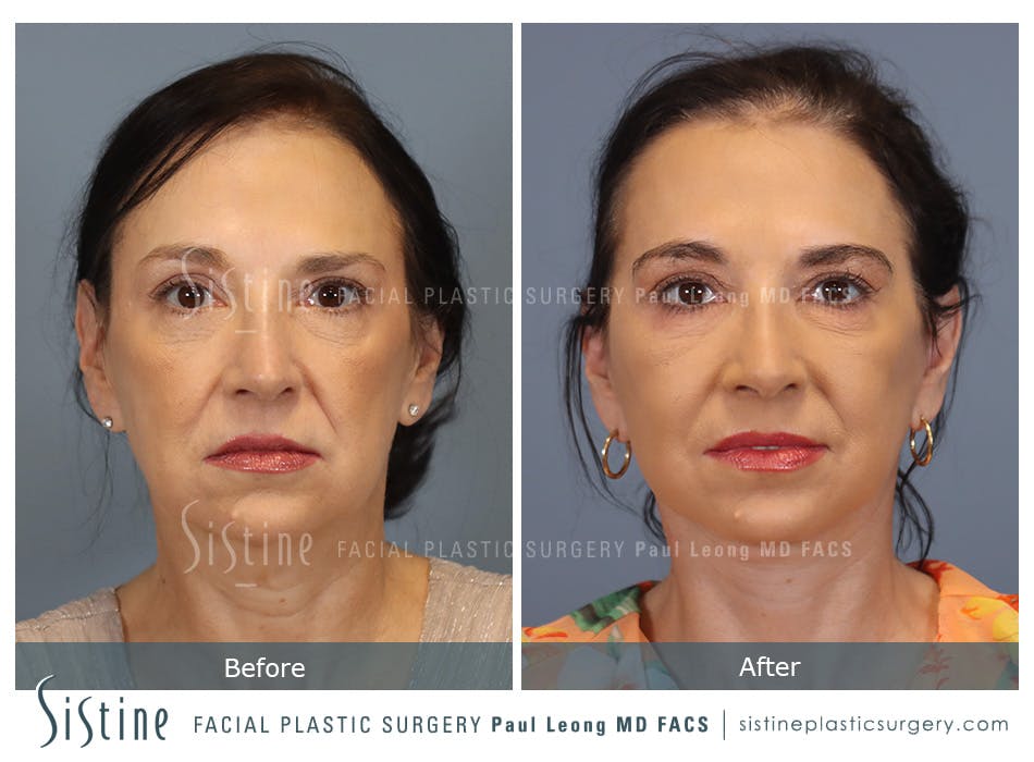 Facelift Before and After | Leong Facial Plastic Surgery