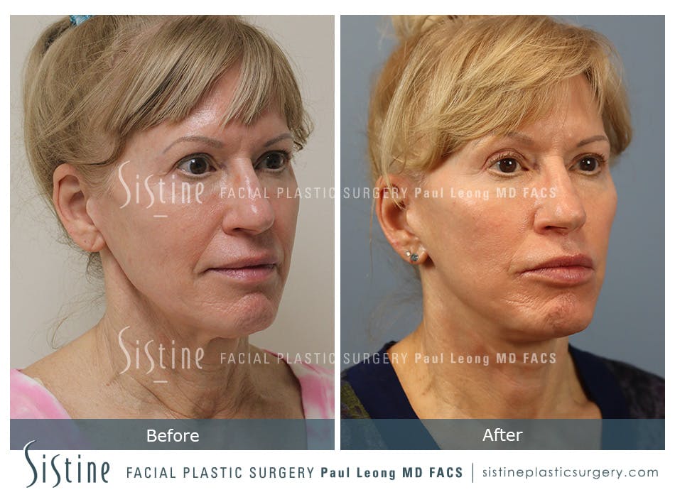 Facelift Before and After | Leong Facial Plastic Surgery