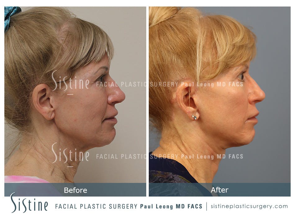 Facelift Before and After | Leong Facial Plastic Surgery