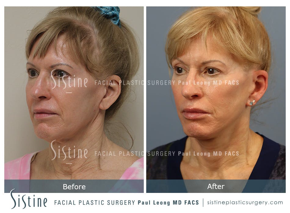 Facelift Before and After | Leong Facial Plastic Surgery