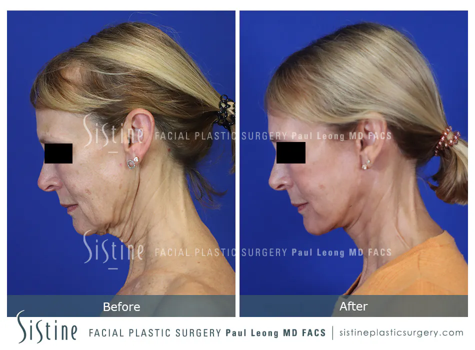 High SMAS Facelift in Pittsburgh - Preoperative Frontal View | Sistine Facial Plastic Surgery