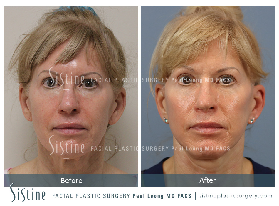 Facelift Before and After 21 | Leong Facial Plastic Surgery