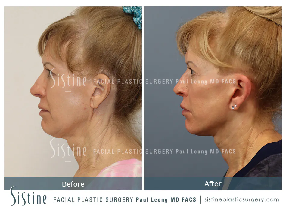 Facelift Before and After | Leong Facial Plastic Surgery