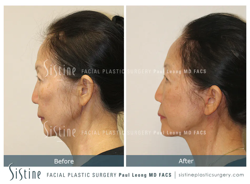 Facelift Before and After | Leong Facial Plastic Surgery