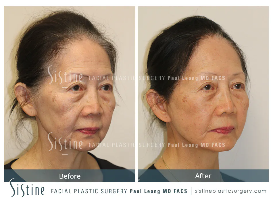 Facelift Before and After | Leong Facial Plastic Surgery