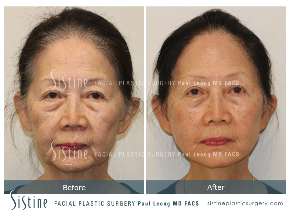 Facelift Before and After 21 | Leong Facial Plastic Surgery