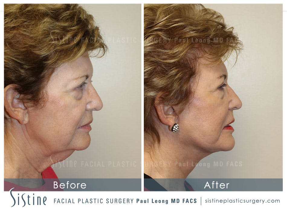 Facelift Before and After | Leong Facial Plastic Surgery