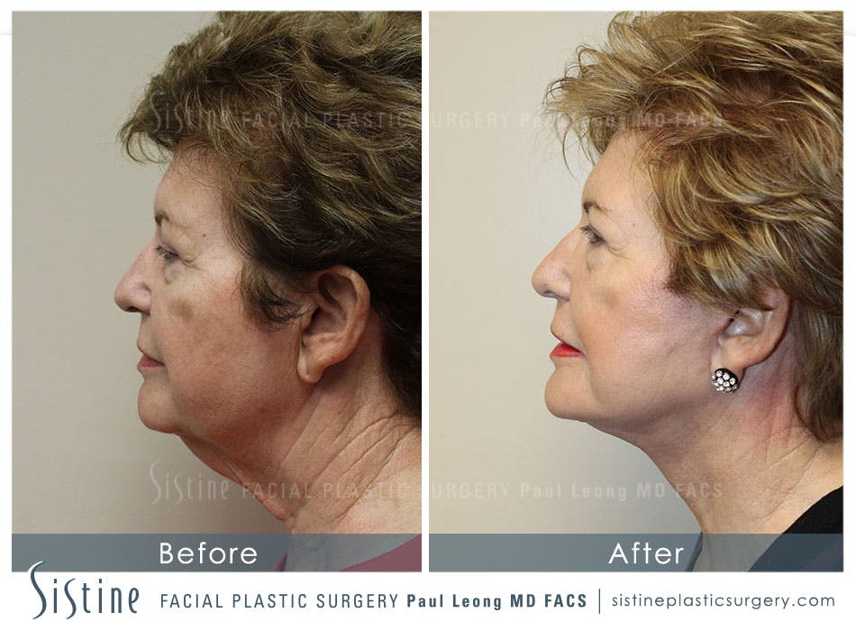Facelift Before and After | Leong Facial Plastic Surgery