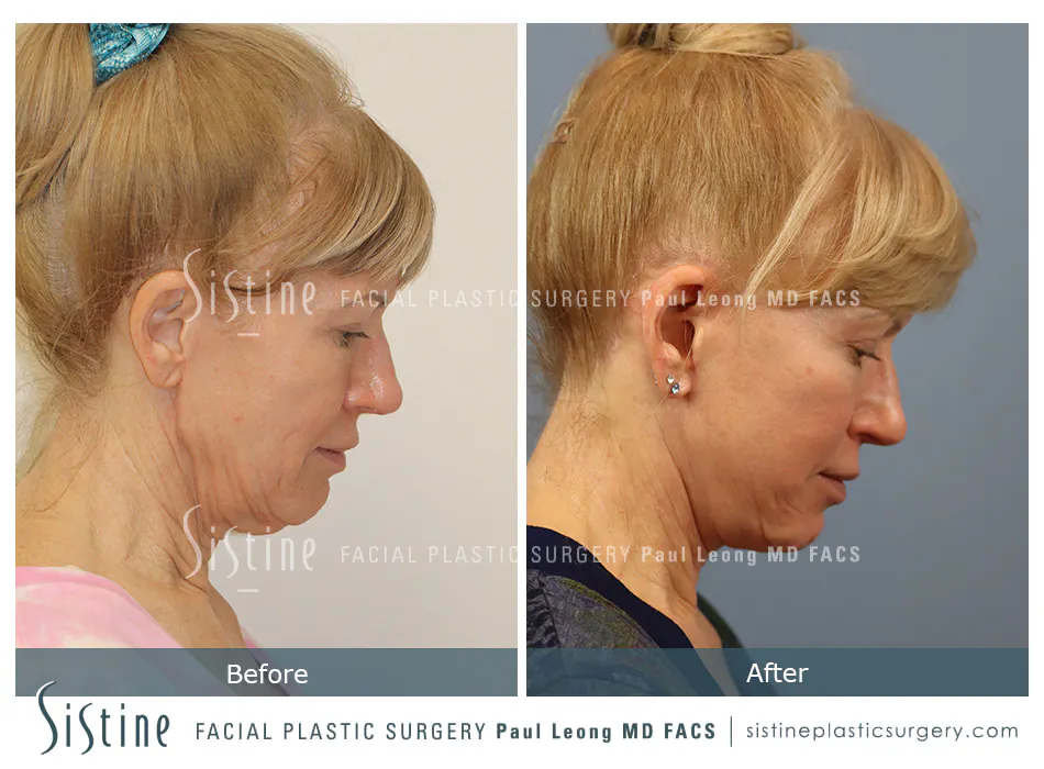 Pittsburgh High SMAS Facelift - Preoperative Left Later Chin Tucked View  Sistine Facial Plastic Surgery