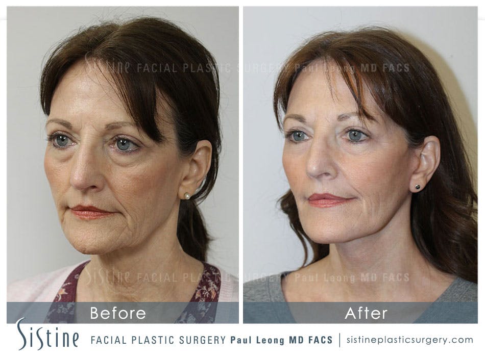 Facelift Before and After | Leong Facial Plastic Surgery