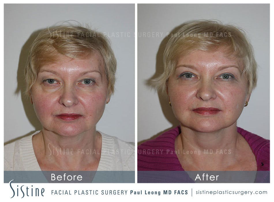 Facelift Before and After | Leong Facial Plastic Surgery