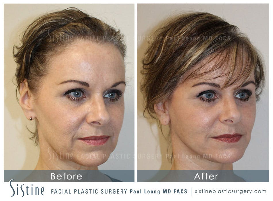 Facelift Before and After | Leong Facial Plastic Surgery