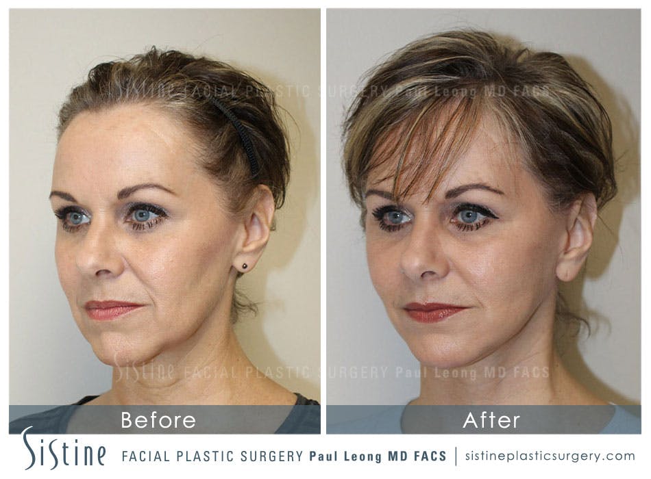 Facelift Before and After | Leong Facial Plastic Surgery