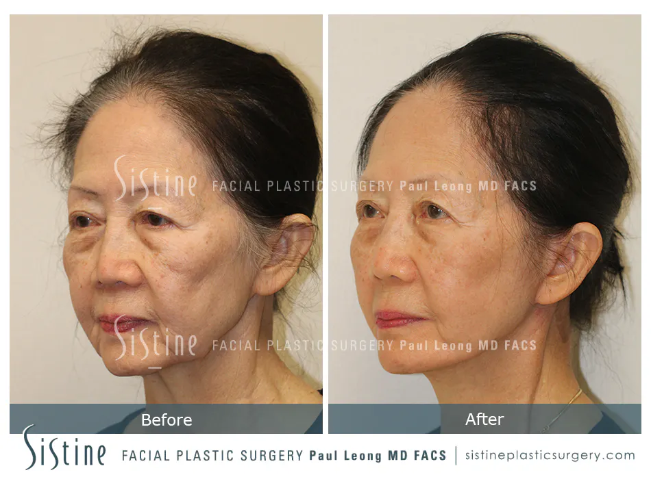 SMAS Face and Neck Lift Pittsburgh - Preoperative Right Lateral View | Dr. Paul Leong
