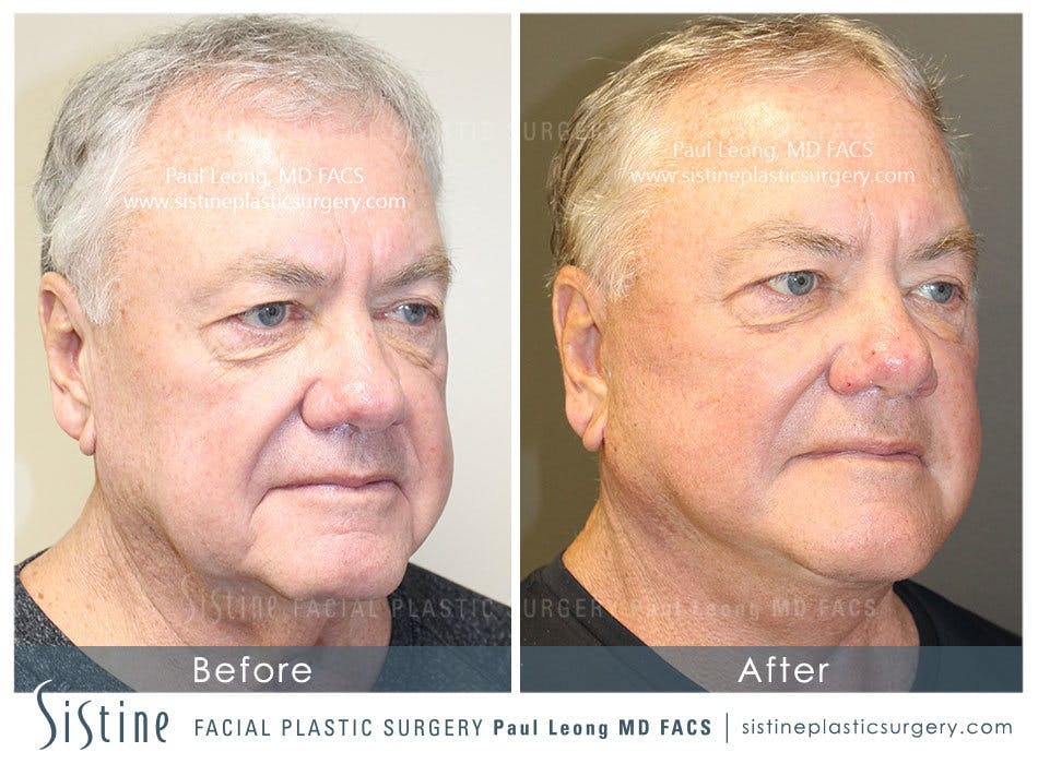 Facelift Before and After | Leong Facial Plastic Surgery