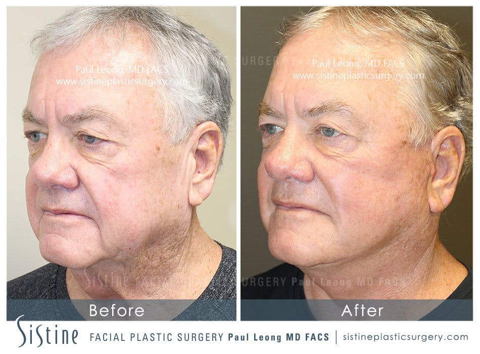 Facelift Before and After | Leong Facial Plastic Surgery