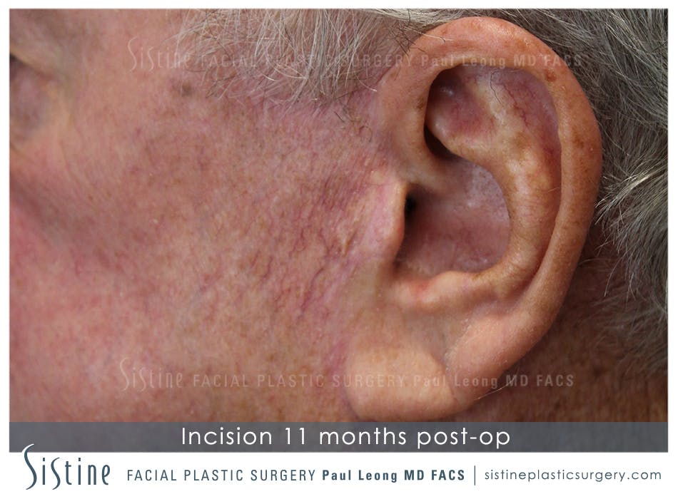 Facelift Before and After | Leong Facial Plastic Surgery