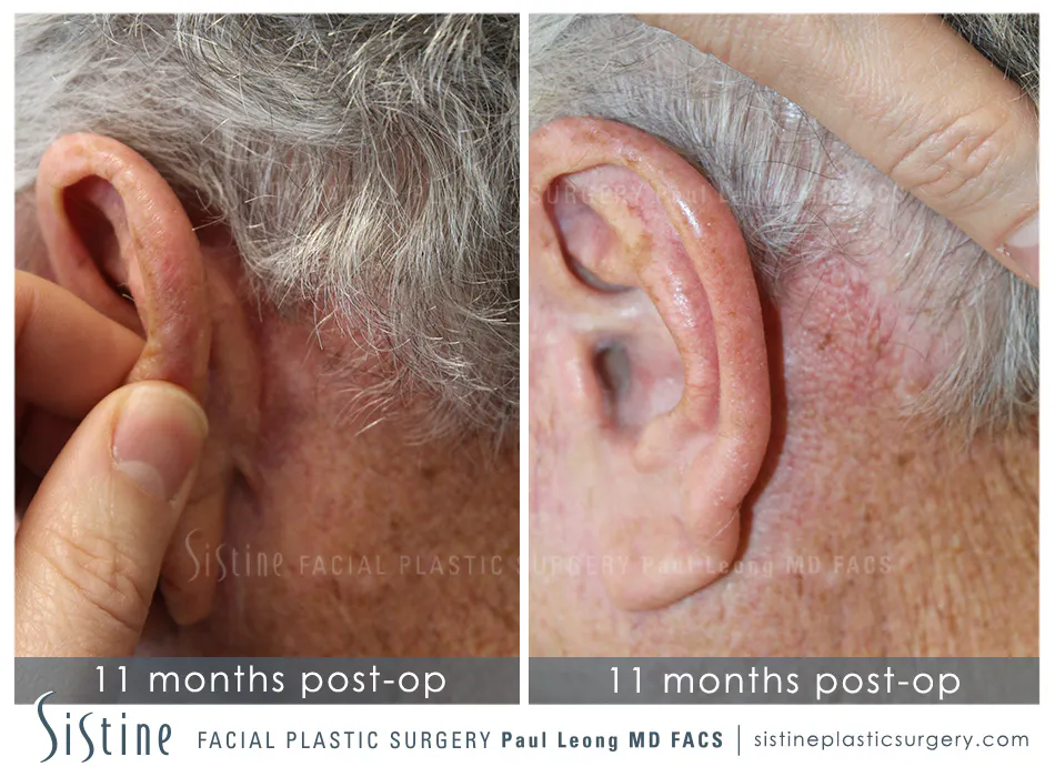 Facelift Before and After | Leong Facial Plastic Surgery