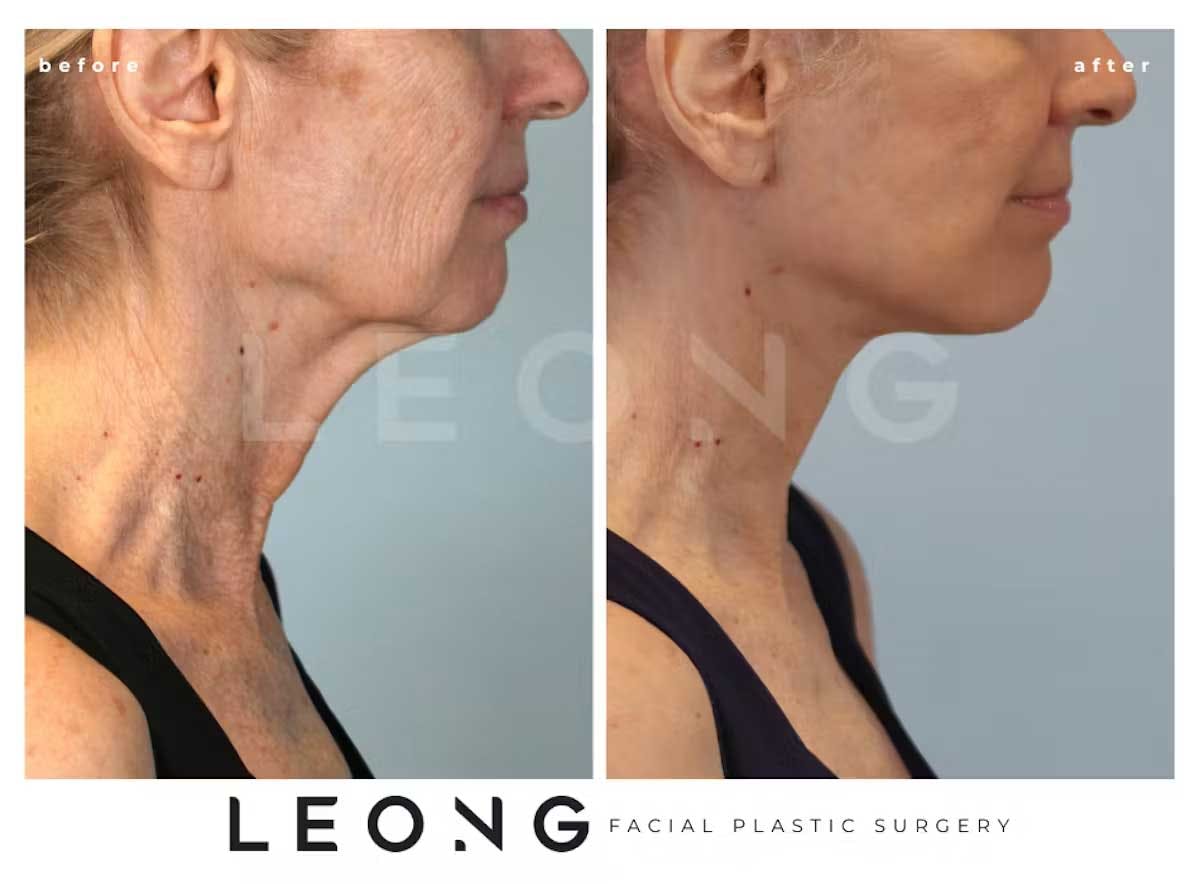 Facelift Before and After | Leong Facial Plastic Surgery