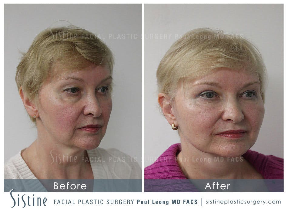 Facelift Before and After | Leong Facial Plastic Surgery
