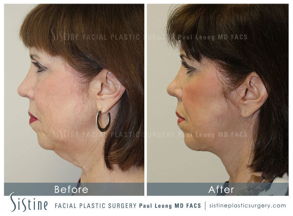 Facelift Before and After | Leong Facial Plastic Surgery