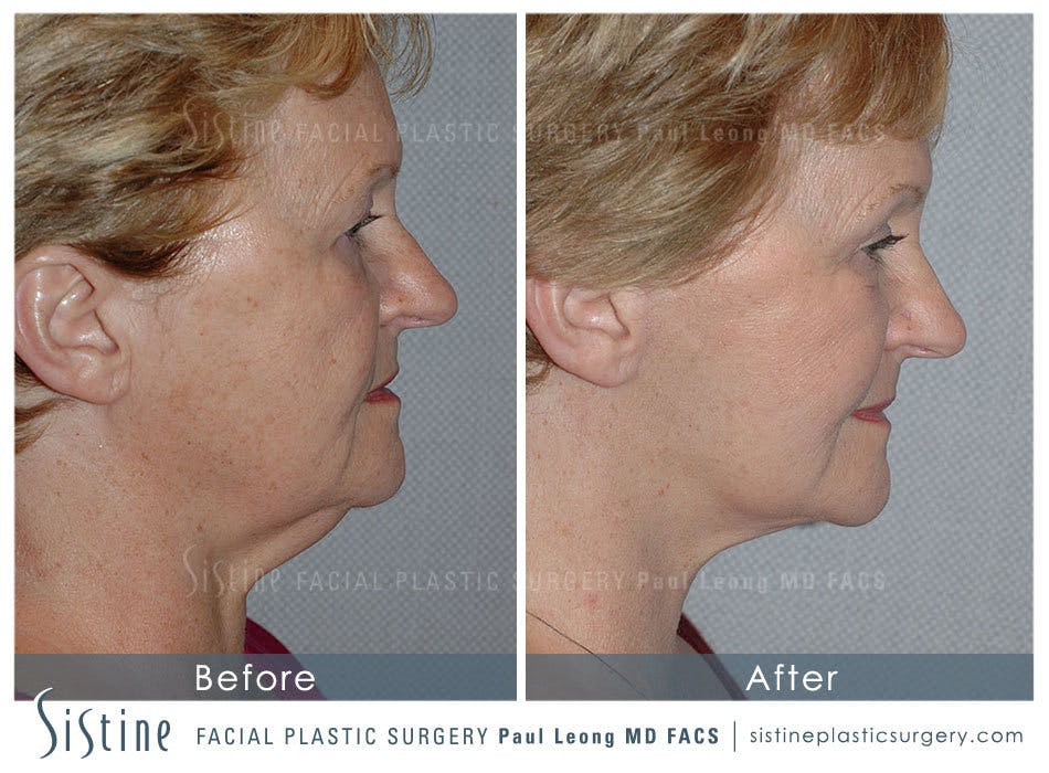 Facelift Before and After | Leong Facial Plastic Surgery