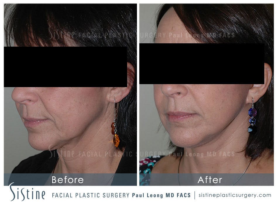 Facelift Before and After | Leong Facial Plastic Surgery