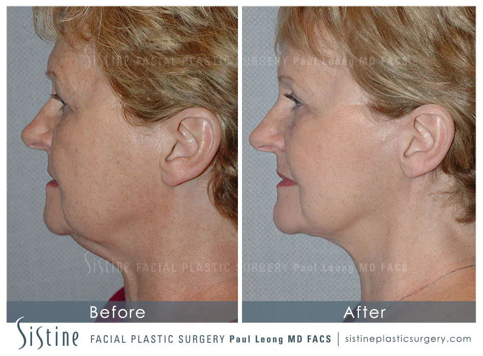 Facelift Before and After | Leong Facial Plastic Surgery