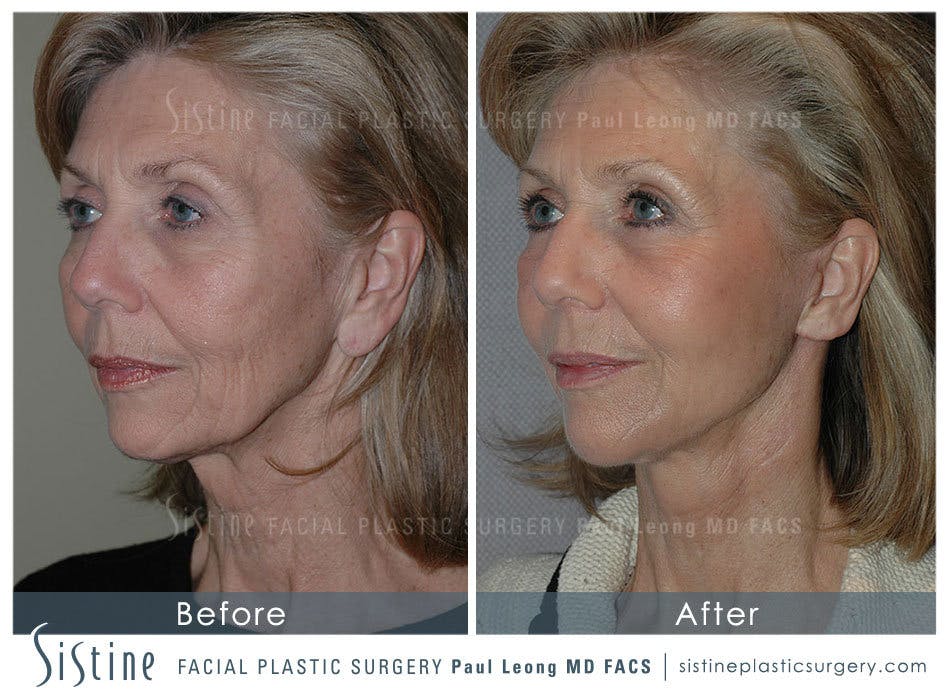Facelift Before and After | Leong Facial Plastic Surgery