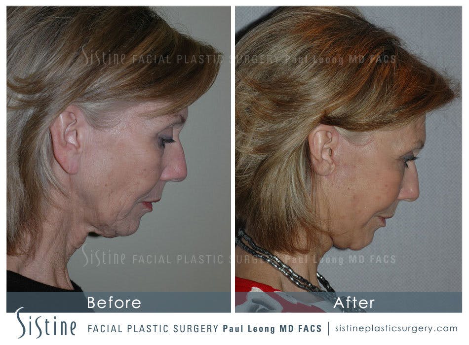 Facelift Before and After | Leong Facial Plastic Surgery