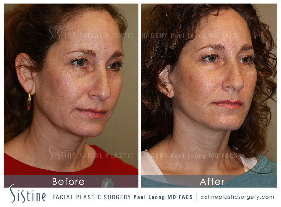 Facelift Before and After | Leong Facial Plastic Surgery