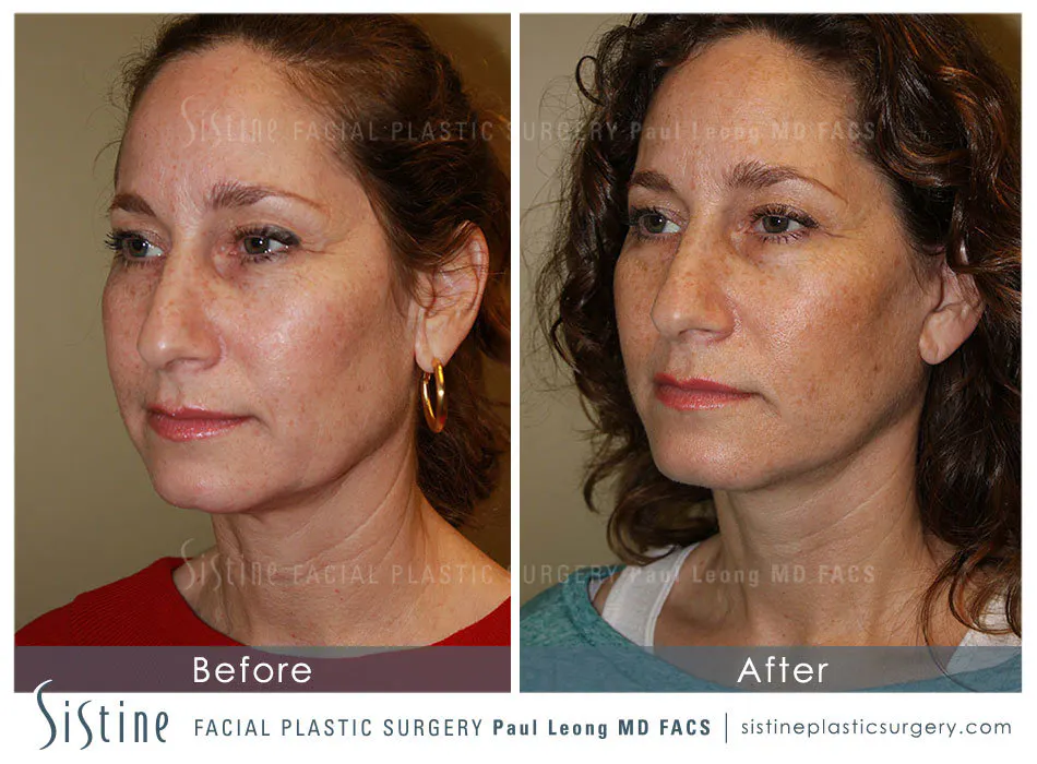 Facelift Before and After | Leong Facial Plastic Surgery