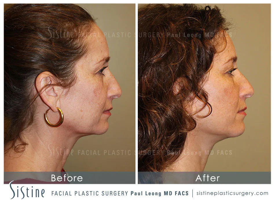 Facelift Before and After | Leong Facial Plastic Surgery