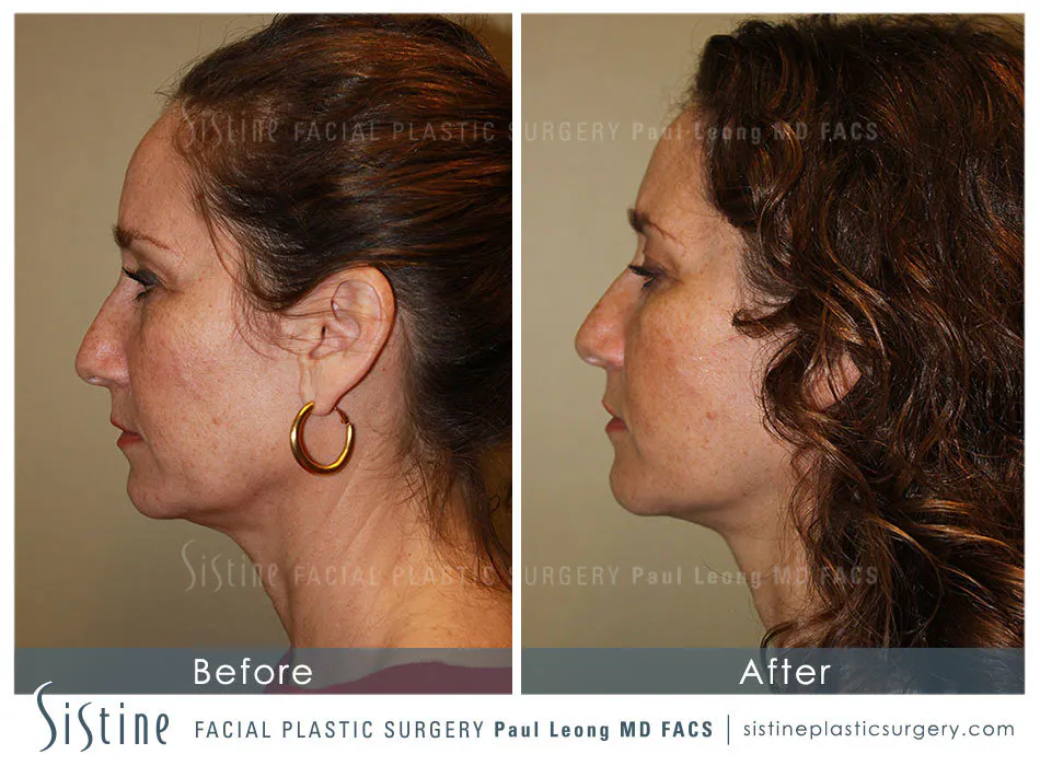 Facelift Before and After | Leong Facial Plastic Surgery