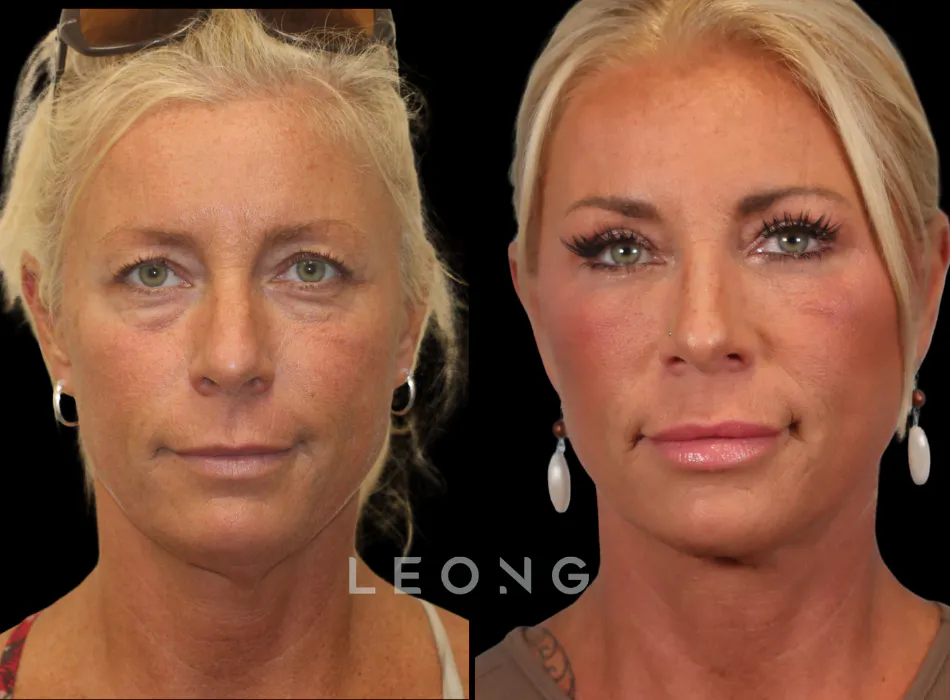 Facelift Before and After | Leong Facial Plastic Surgery