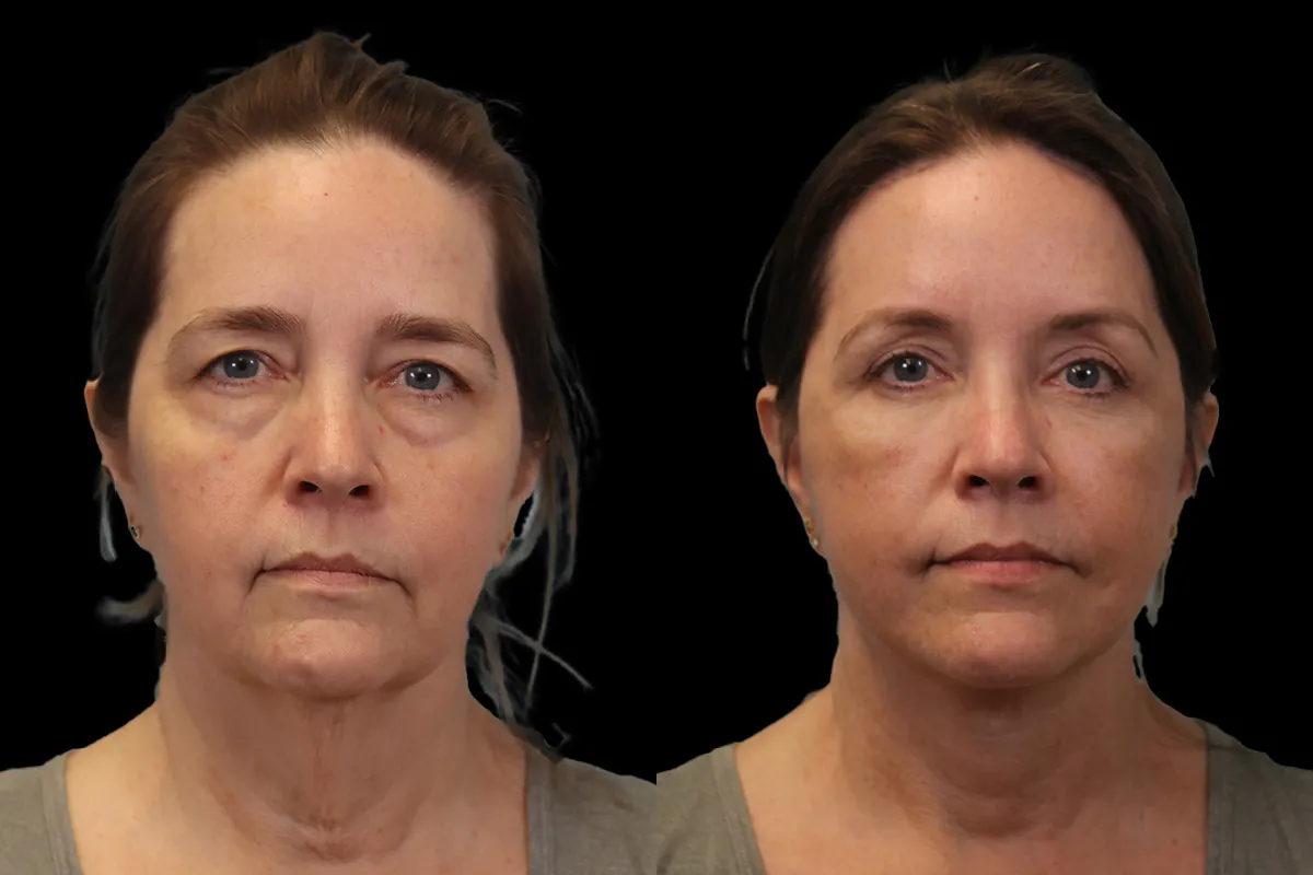 Facelift Before and After | Leong Facial Plastic Surgery