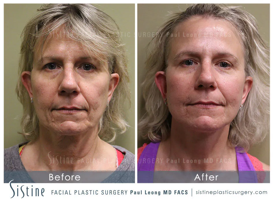High SMAS Facelift in Pittsburgh - Preoperative Frontal View | Sistine Facial Plastic Surgery