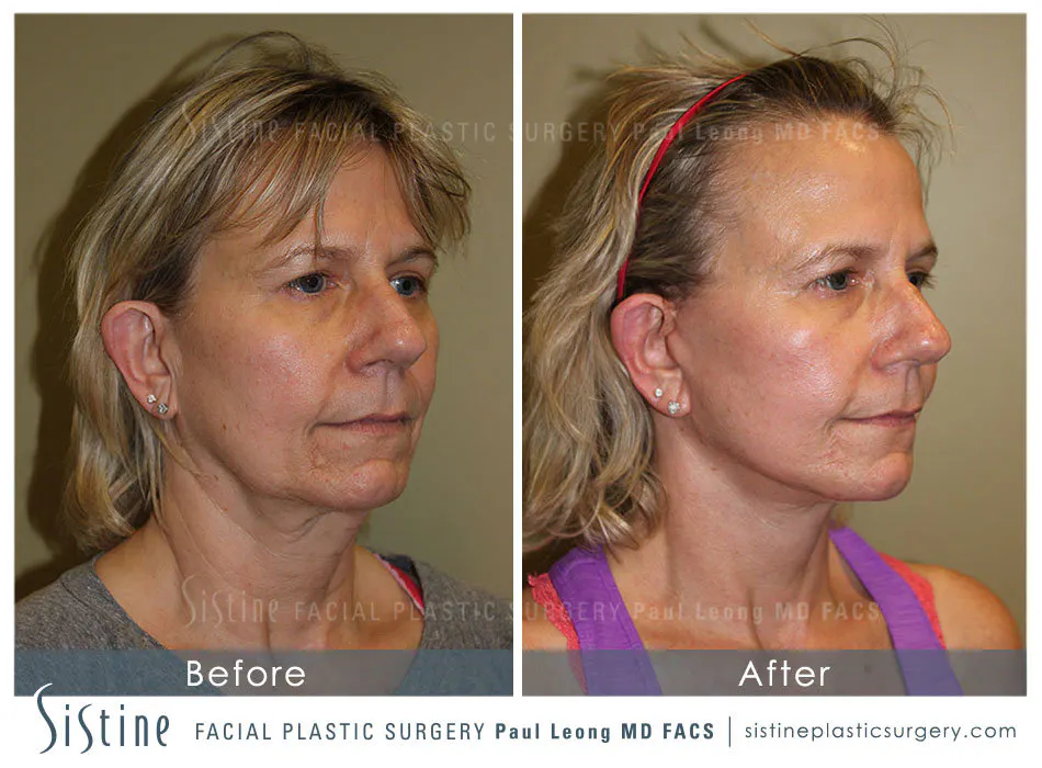 Pittsburgh High SMAS Facelift - Preoperative Left Oblique View | Sistine Facial Plastic Surgery