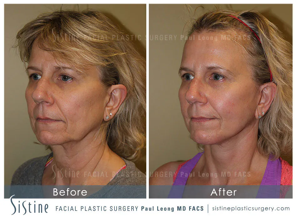 Pittsburgh High SMAS Facelift - Preoperative Right Oblique View | Sistine Facial Plastic Surgery