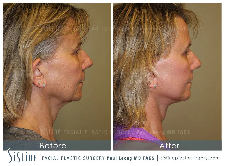 Pittsburgh High SMAS Facelift - Preoperative Right Lateral View | Sistine Facial Plastic Surgery