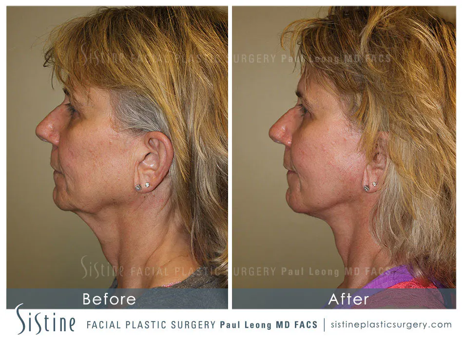Pittsburgh High SMAS Facelift - Preoperative Left Later Chin Tucked View  Sistine Facial Plastic Surgery
