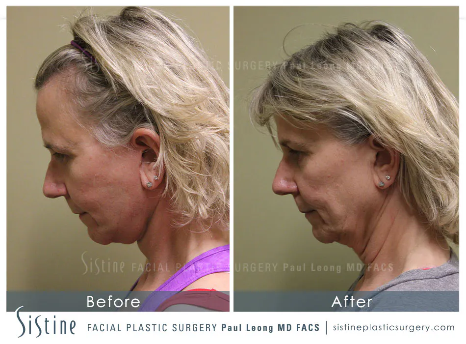 Pittsburgh High SMAS Facelift - Preoperative Left Later Chin Tucked View  Sistine Facial Plastic Surgery