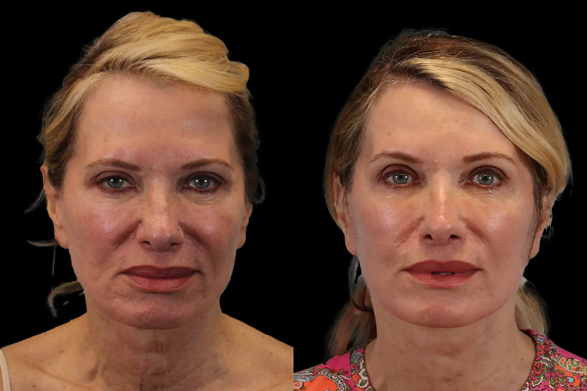 Facelift Before and After | Leong Facial Plastic Surgery