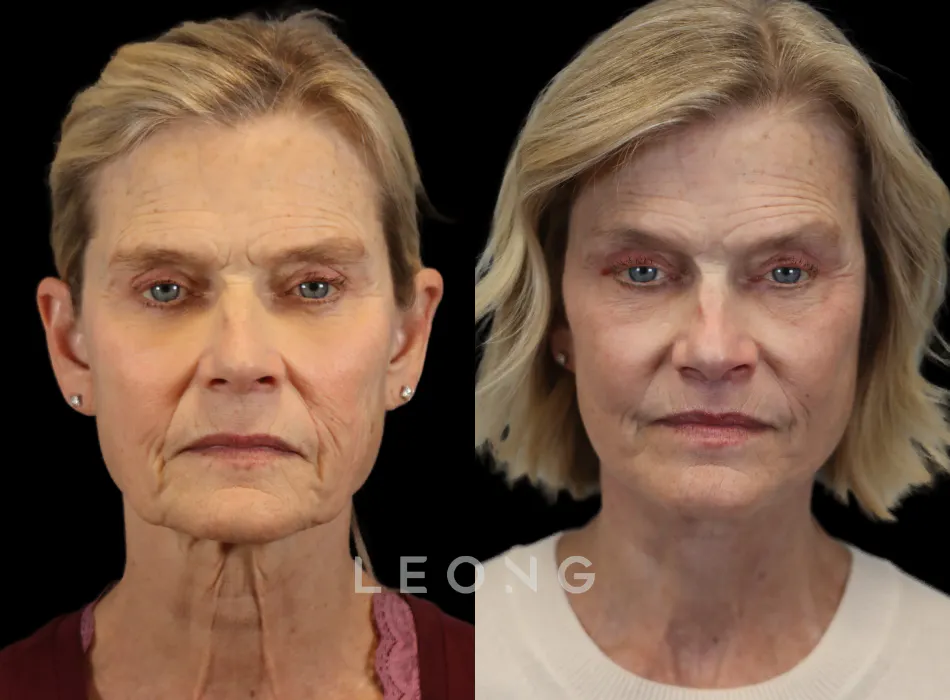 Facelift Before and After | Leong Facial Plastic Surgery