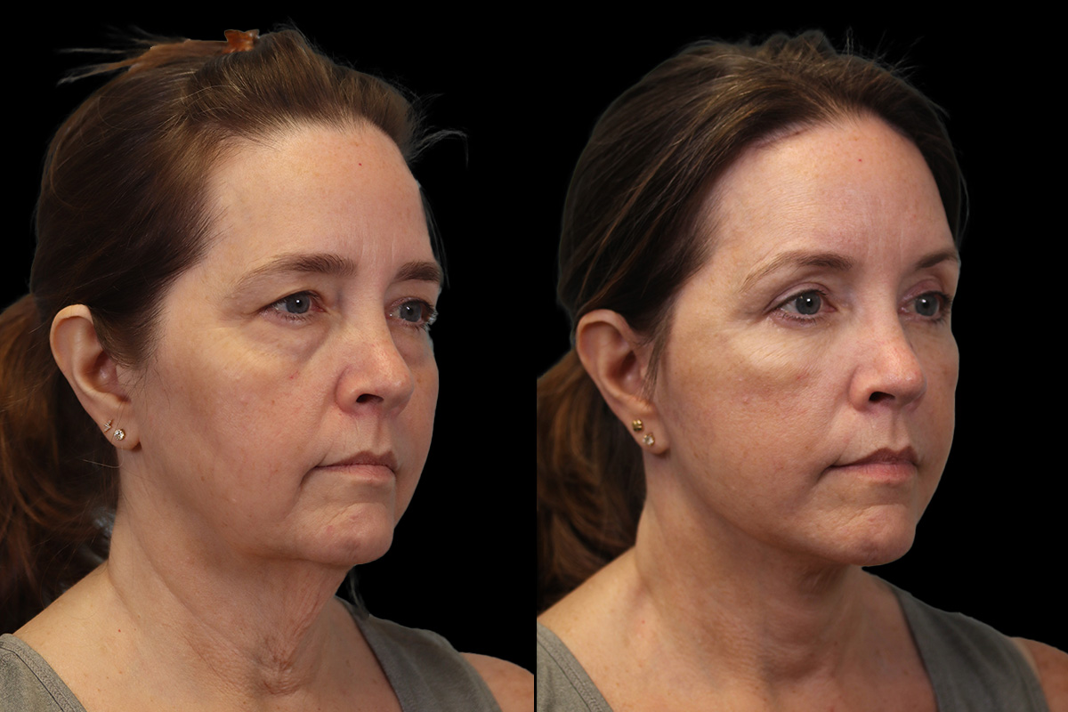 Male Facelift Pittsburgh PA - Before Photo | Sistine Facial Plastic Surgery