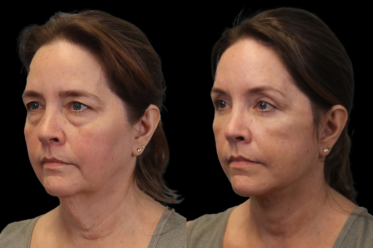  Facelift for Men Pittsburgh - Before Surgery | Sistine Facial Plastic Surgery