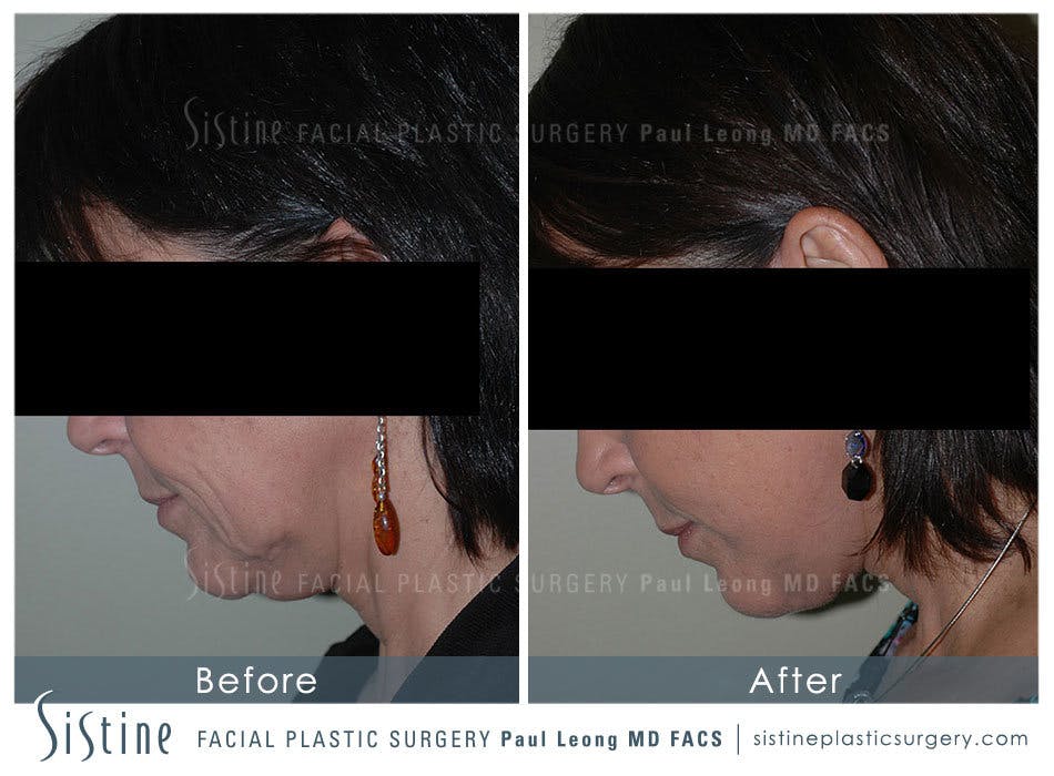 Fat Transfer Injections Before and After | Leong Facial Plastic Surgery