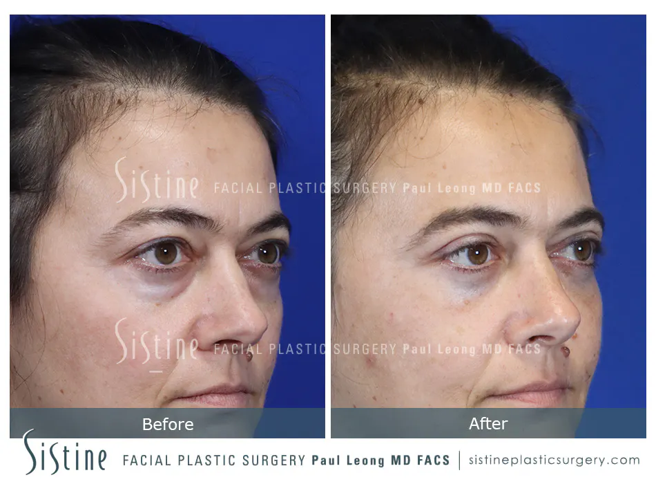 Fat Transfer Injections Before and After | Leong Facial Plastic Surgery